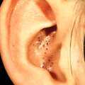 Черные точки у ребенка в ушах: как убрать? Причины и лечение в домашних условиях