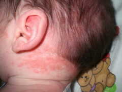 Потница на коже головы у грудничка под волосами: симптомы и лечение в домашних условиях
