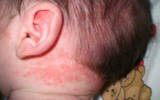 Потница на коже головы у грудничка под волосами: симптомы и лечение в домашних условиях