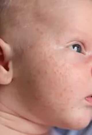 Чем отличается аллергическая сыпь от потницы: несколько отличий от детского аллерголога