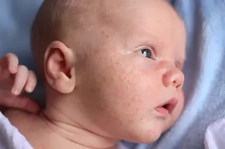 Чем отличается аллергическая сыпь от потницы: несколько отличий от детского аллерголога