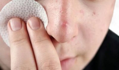 Внутренний чирий на лице: причины и лечение народными средствами в домашних условиях