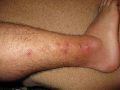 Лечение фурункула (чирея) на ноге, фото