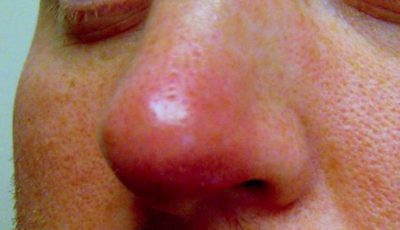 Фурункул на носу: причины и лечение в домашних условиях народными средствами