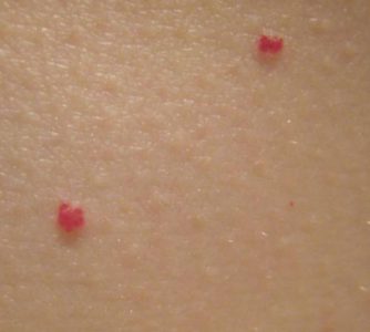 Кровяный прыщи на коже: причины и лечение в домашних условиях